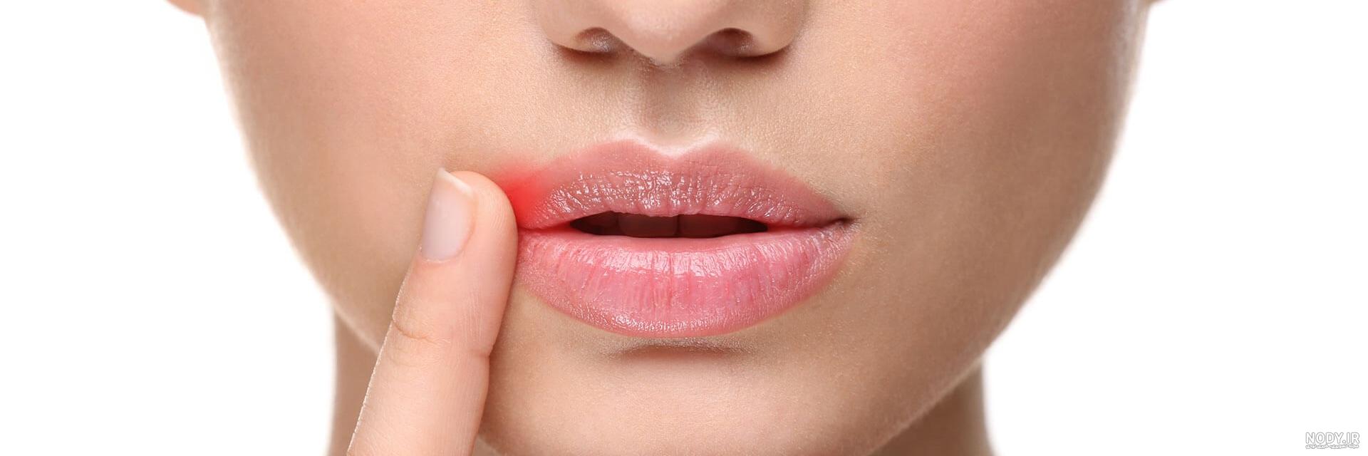 بررسی علل و روش‌های درمان آفت دهان کودکان | دندانپزشکی شبانه روزی تاج