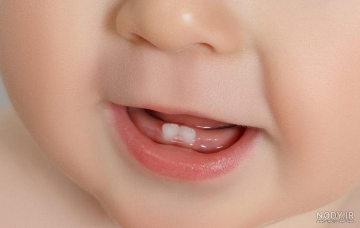 بررسی علل و روش‌های درمان آفت دهان کودکان | دندانپزشکی شبانه روزی تاج