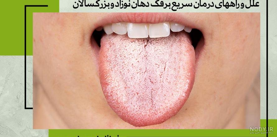 برفک دهان نوزاد چیست؟ تشخیص و درمان برفک دهان نوزاد | پذیرش۲۴