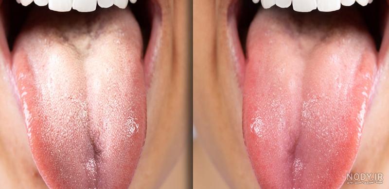 برفک دهان نوزاد چیست؟علائم و درمان آن