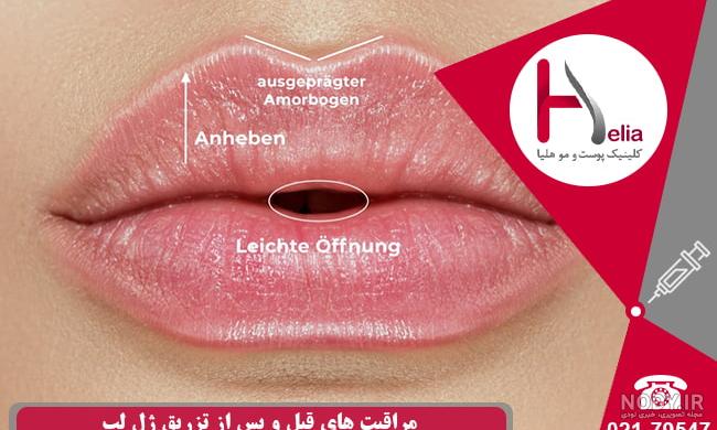 برق لب حرارتی قلبی مدل جدید – ویترین خاص برق لب حرارتی قلبی مدل جدید – ویترین خاص