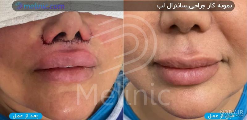 بهترین دکتر سانترال لب در مشهد؛ هزینه لیفت لب 1403 | پزشک ۲۴ بهترین دکتر سانترال لب در مشهد؛ هزینه لیفت لب 1403 | پزشک ۲۴