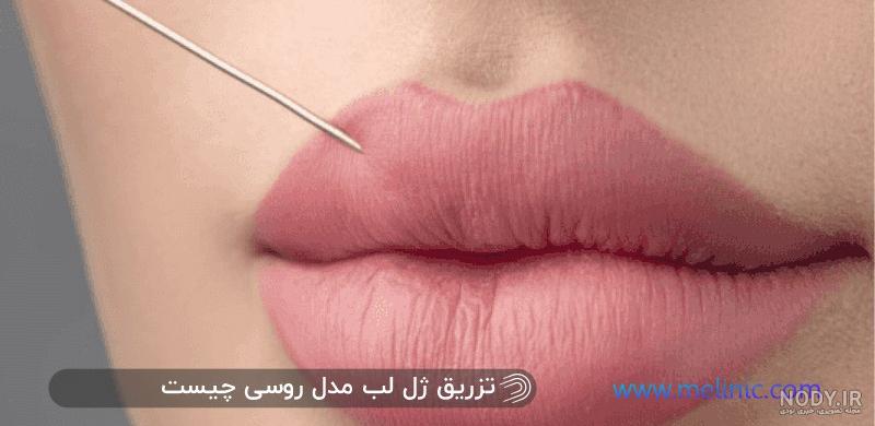 بهترین قیمت تزریق ژل مدل لب روسی - کلینیک تخصصی زیبایی دکتر سعیدزاده بهترین قیمت تزریق ژل مدل لب روسی - کلینیک تخصصی زیبایی دکتر سعیدزاده