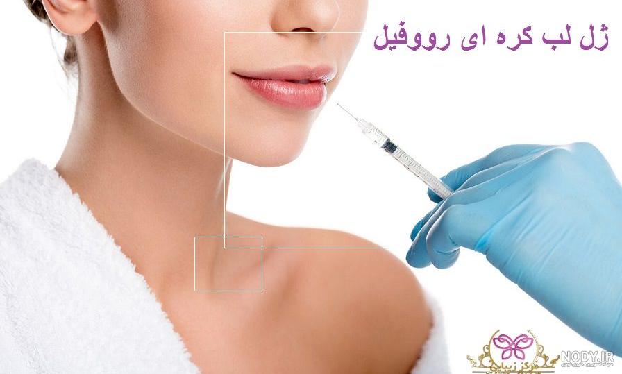 بهترین مارک ژل لب (ژوویدرم، رووفیل یا پرفکتا؟) | قیمت بهترین مارک ژل لب - کلینیک زیبایی آیریس بهترین مارک ژل لب (ژوویدرم، رووفیل یا پرفکتا؟) | قیمت بهترین مارک ژل لب - کلینیک زیبایی آیریس