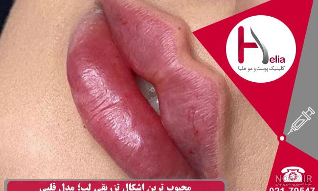 بهترین مدل های تزریق ژل لب - بساز و بچین بهترین مدل های تزریق ژل لب - بساز و بچین