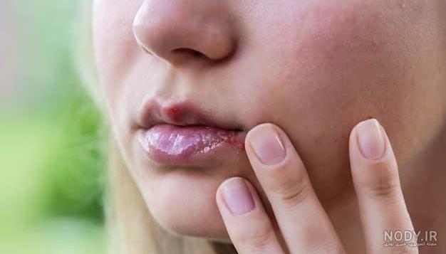 تاول لب نوزاد: علل، علائم و نکاتی برای مقابله با آن - پینو بیبی تاول لب نوزاد: علل، علائم و نکاتی برای مقابله با آن - پینو بیبی