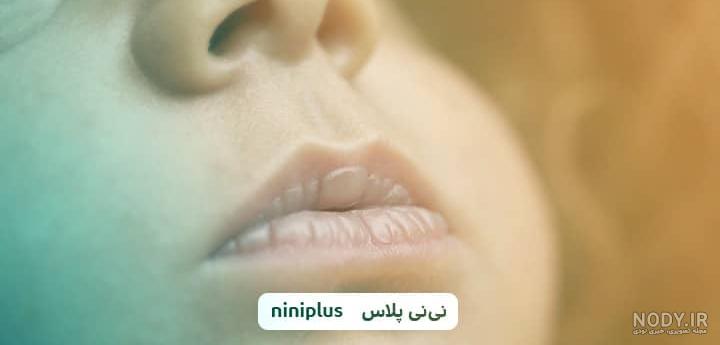 تبخال لب و دهان در کودکان علت علائم و درمان سریع آن | تاول‌ها | ارتودنسی  اطفال
