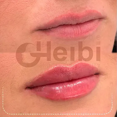 تزریق لب به روش روسی (Russian lips) - وبسایت دکتر سید حسن طبا طبایی نژاد تزریق لب به روش روسی (Russian lips) - وبسایت دکتر سید حسن طبا طبایی نژاد
