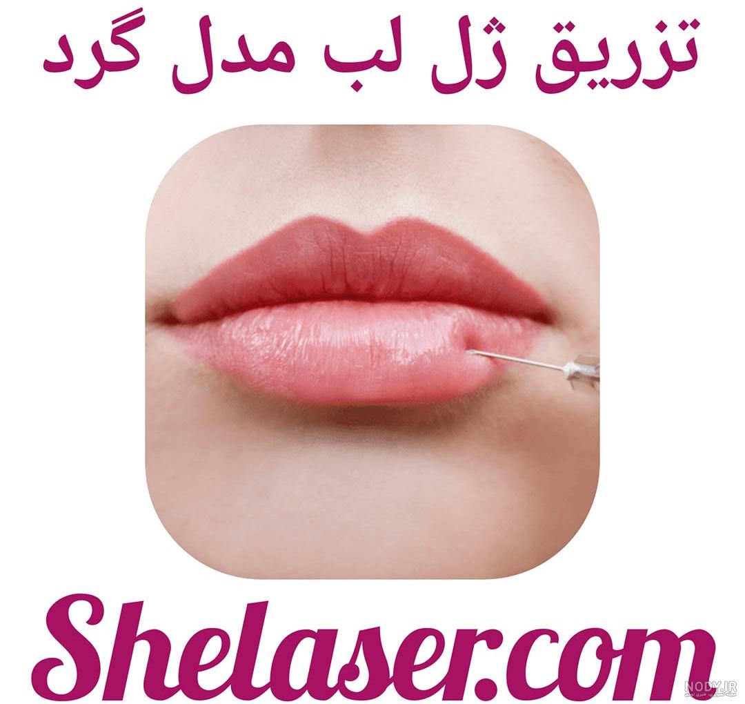 تزریق ژل خط خنده [✓ تزریق فیلر خط خنده و عکس قبل و بعد + هزینه 1403] - دکتر  زیبایی من | آیبلا