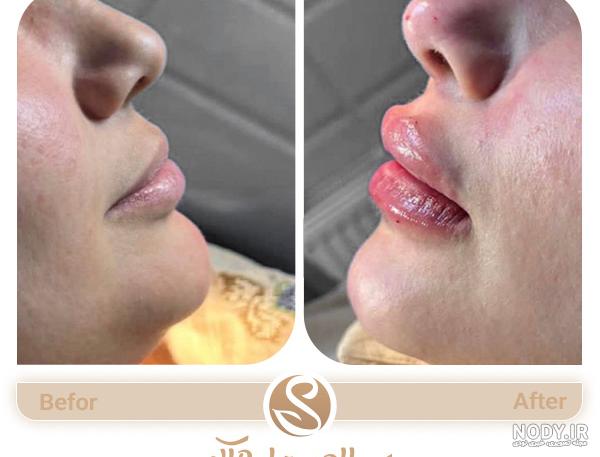 تزریق ژل خط خنده (عوارض، ماندگاری، قیمت و عکس های قبل و بعد انجام آن) تزریق ژل خط خنده (عوارض، ماندگاری، قیمت و عکس های قبل و بعد انجام آن)