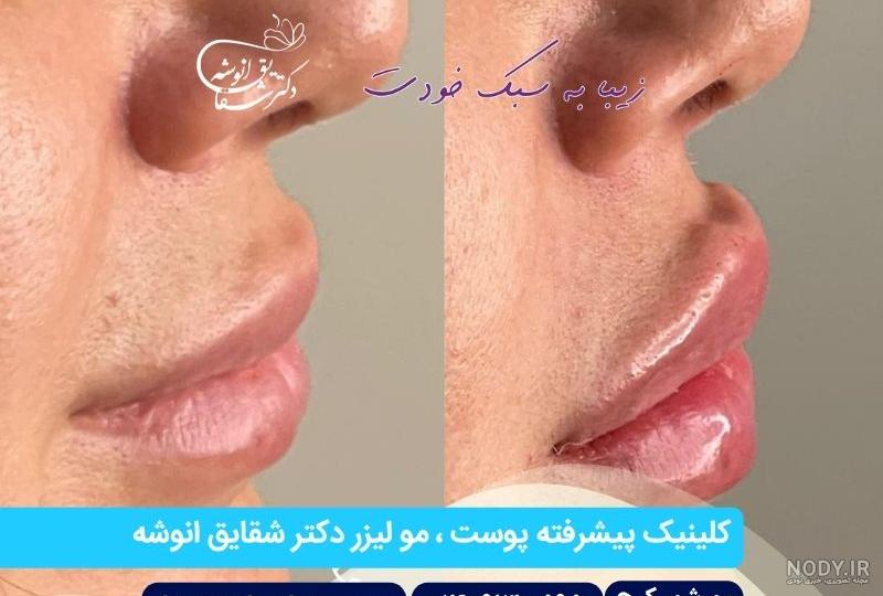 تزریق ژل خط خنده - معرفی بهترین مارک ها - مزایا + معایب - دکتر امامی تزریق ژل خط خنده - معرفی بهترین مارک ها - مزایا + معایب - دکتر امامی