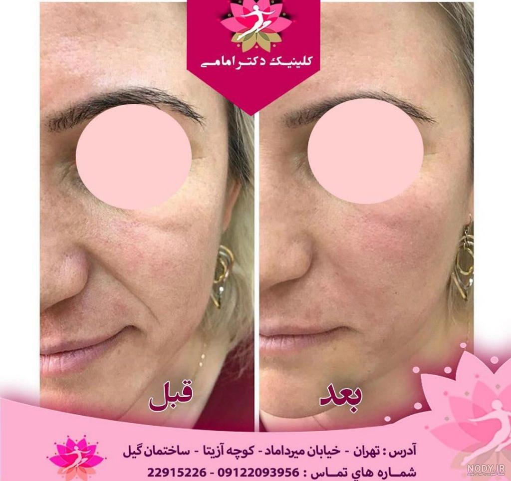 تزریق ژل خط خنده چیست؟ و مزایا و عوارض آن چیست؟ تزریق ژل خط خنده چیست؟ و مزایا و عوارض آن چیست؟