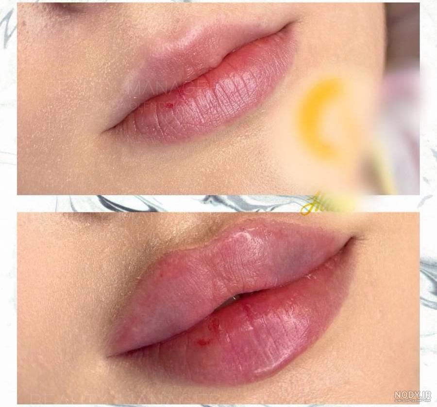 تزریق ژل لب و انواع مدل های آن - دکتر پیشگاهی