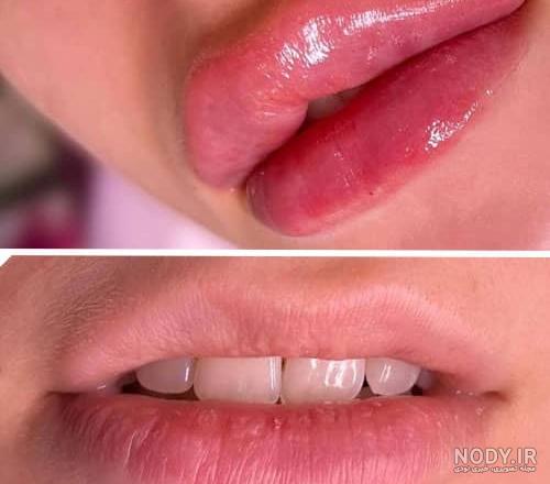 تزریق ژل لب و انواع مدل های آن - دکتر پیشگاهی تزریق ژل لب و انواع مدل های آن - دکتر پیشگاهی