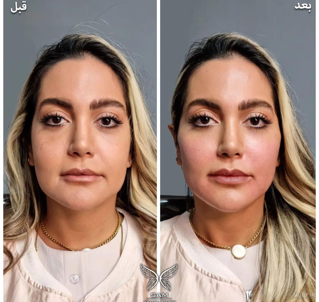 تزریق ژل لب و انواع مدل های آن - دکتر پیشگاهی