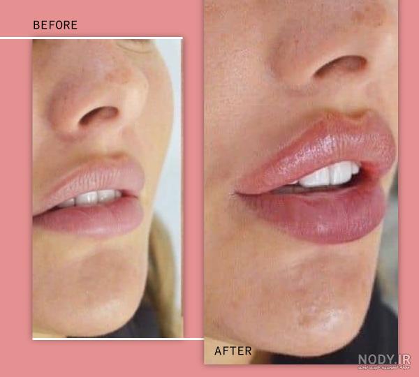 تزریق ژل لب و انواع مدل های آن - دکتر پیشگاهی