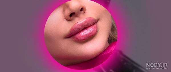 تزریق ژل لب و انواع مدل های آن - دکتر پیشگاهی تزریق ژل لب و انواع مدل های آن - دکتر پیشگاهی
