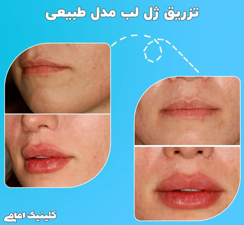 تزریق ژل لب در تهران | راهنمای کامل + قیمت به‌روز