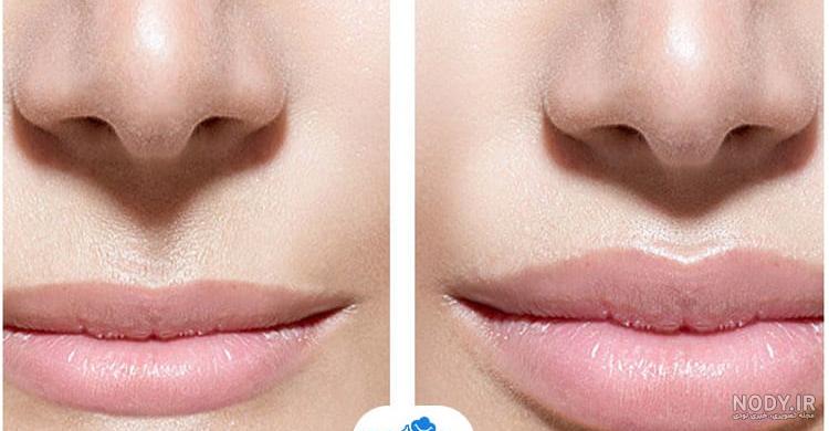 تزریق ژل لب | راهنمای مزایا ، برند ها و قیمت فیلر لب