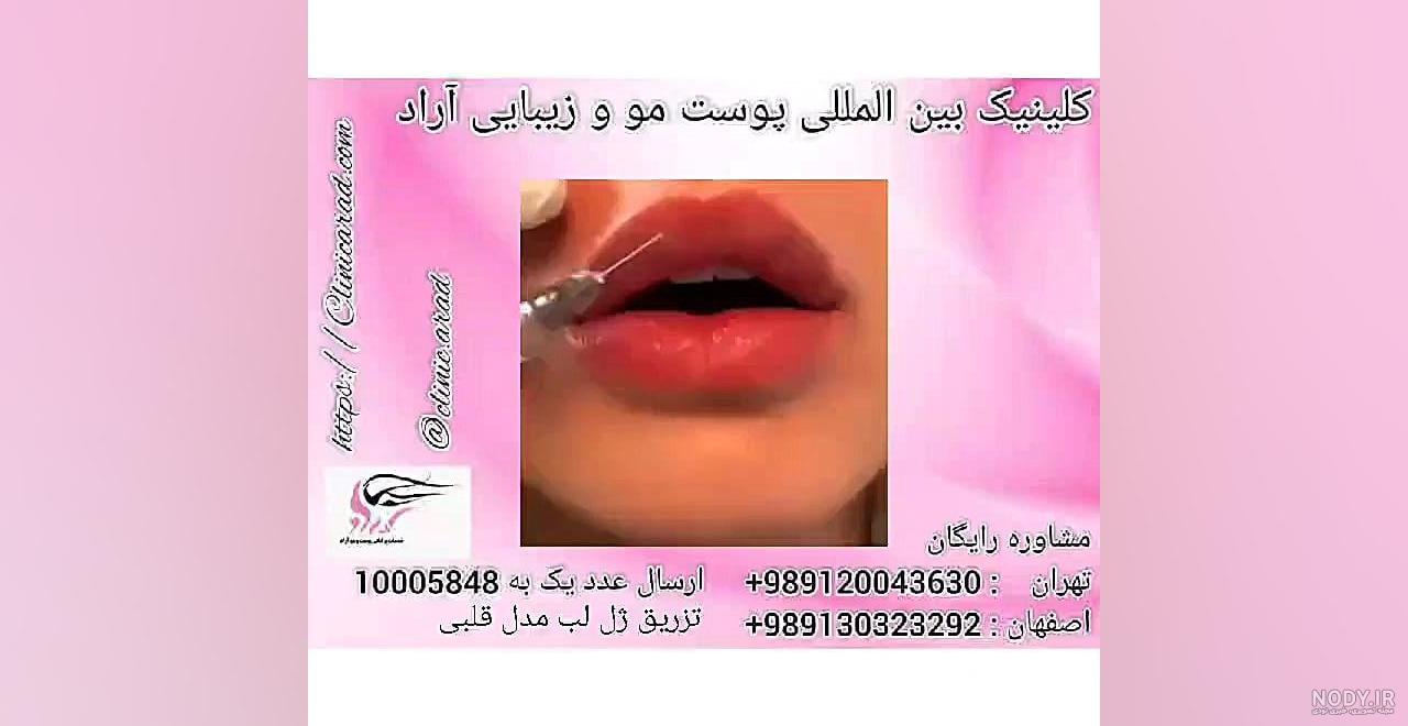 تزریق ژل لب | راهنمای مزایا ، برند ها و قیمت فیلر لب تزریق ژل لب | راهنمای مزایا ، برند ها و قیمت فیلر لب