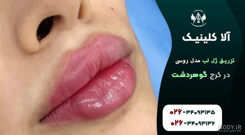 تزریق ژل لب روسی با ماندگاری بالا ← همراه با مشاوره رایگان تزریق ژل لب روسی با ماندگاری بالا ← همراه با مشاوره رایگان