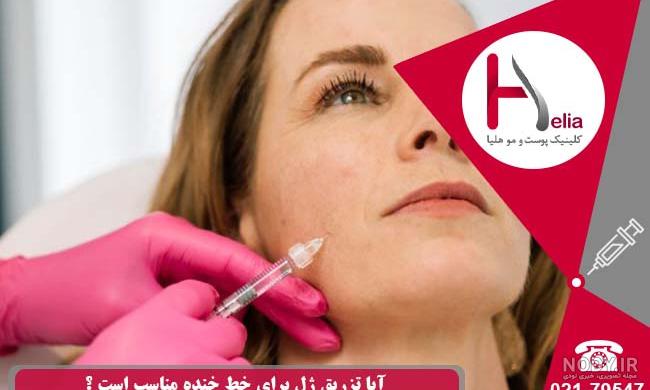 تزریق ژل لب روسی خط دار به شکل طبیعی + عکس قبل و بعد تزریق ژل لب روسی خط دار به شکل طبیعی + عکس قبل و بعد