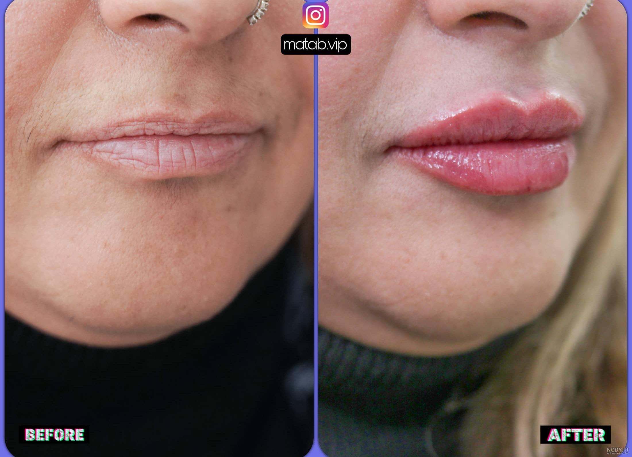تزریق ژل لب روسی خط دار به شکل طبیعی + عکس قبل و بعد تزریق ژل لب روسی خط دار به شکل طبیعی + عکس قبل و بعد