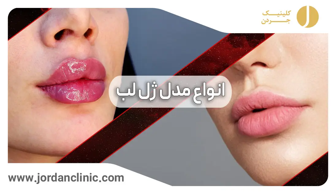تزریق ژل لب روسی خط دار + عکس نمونه - کلینیک هلیا تزریق ژل لب روسی خط دار + عکس نمونه - کلینیک هلیا