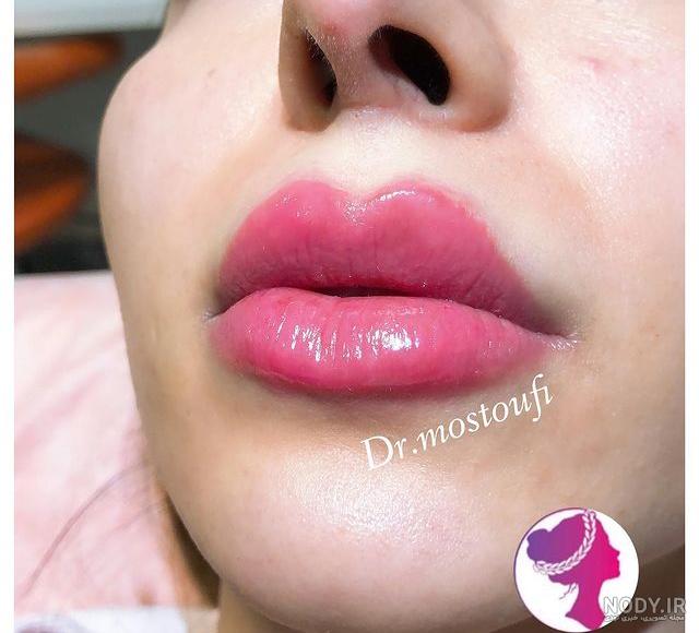 تزریق ژل لب روسی چه فرقی با روش معمولی دارد و عوارض آن چیست؟ — مجله زیبایی لیا تزریق ژل لب روسی چه فرقی با روش معمولی دارد و عوارض آن چیست؟ — مجله زیبایی لیا