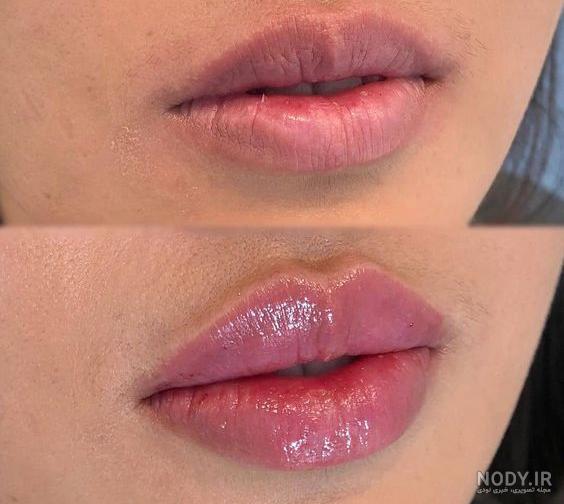 تزریق ژل لب روسی چیست؟ | ملینیک تزریق ژل لب روسی چیست؟ | ملینیک