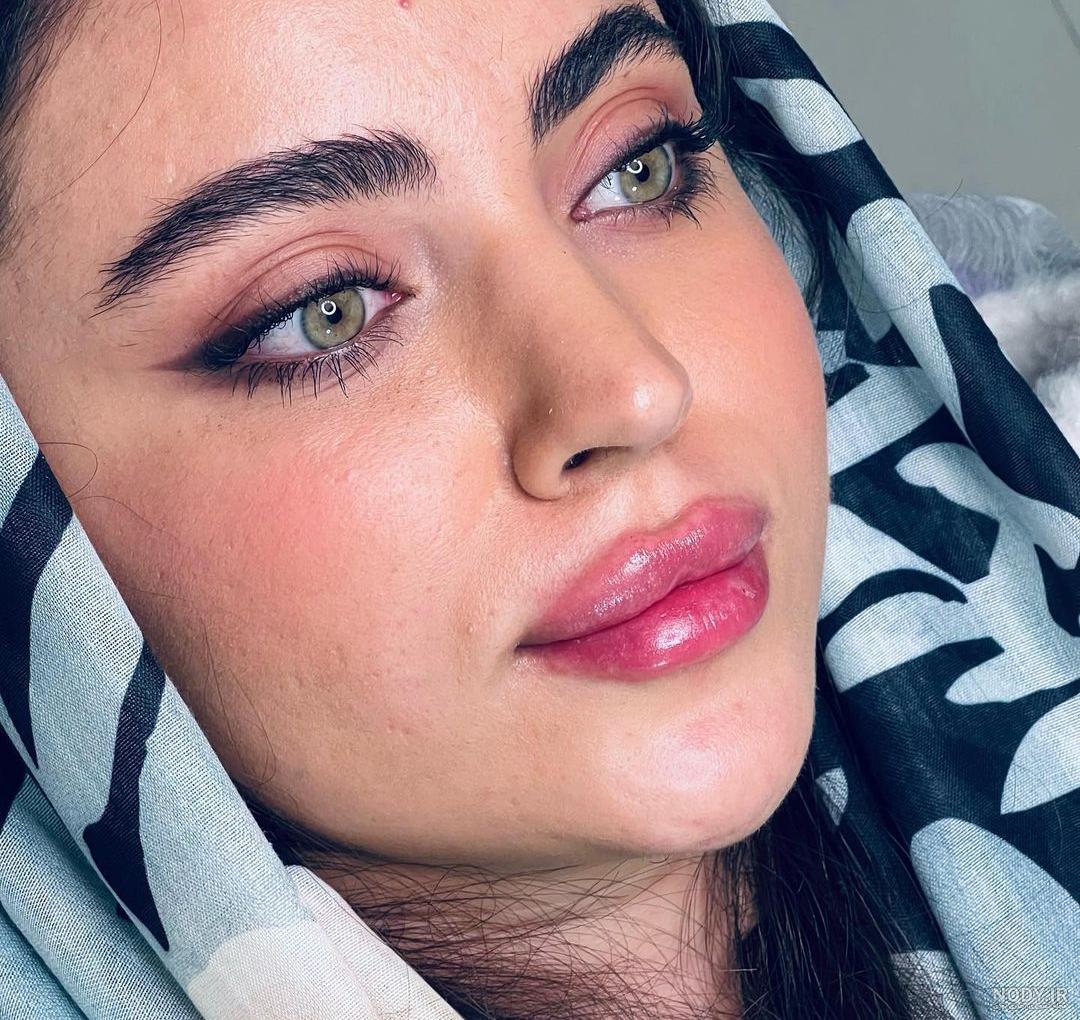 تزریق ژل لب روسی - کلینیک دلتا تزریق ژل لب روسی - کلینیک دلتا