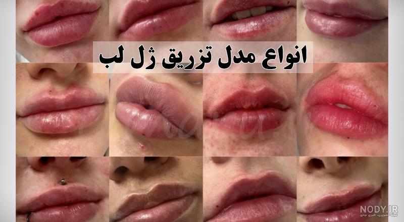 تزریق ژل لب عروسکی چیست؟