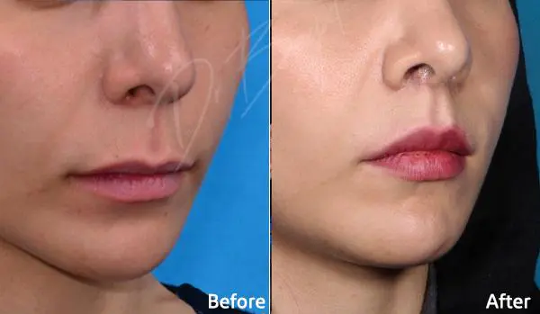 تزریق ژل لب عروسکی در کرج تزریق ژل لب عروسکی در کرج