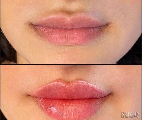 تزریق ژل لب فانتزی: قلبی، گرد، سوتی، قلوه ای، چاک دار — مجله زیبایی لیا تزریق ژل لب فانتزی: قلبی، گرد، سوتی، قلوه ای، چاک دار — مجله زیبایی لیا