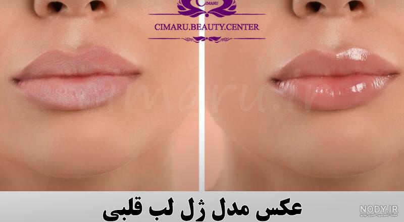 تزریق ژل لب فانتزی: قلبی، گرد، سوتی، قلوه ای، چاک دار — مجله زیبایی لیا تزریق ژل لب فانتزی: قلبی، گرد، سوتی، قلوه ای، چاک دار — مجله زیبایی لیا