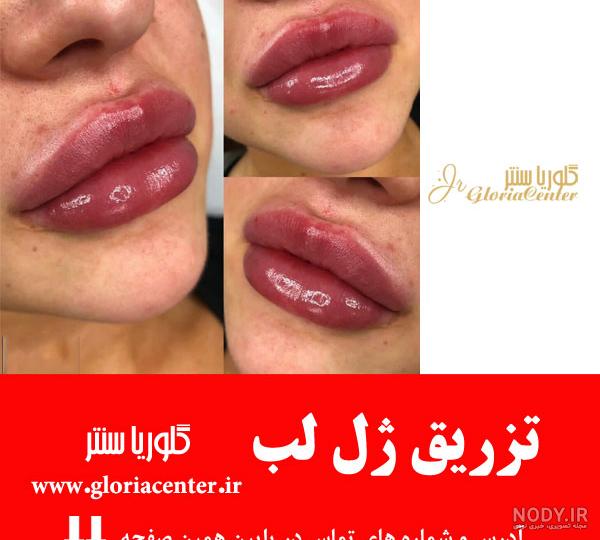 تزریق ژل لب فانتزی: قلبی، گرد، سوتی، قلوه ای، چاک دار — مجله زیبایی لیا تزریق ژل لب فانتزی: قلبی، گرد، سوتی، قلوه ای، چاک دار — مجله زیبایی لیا