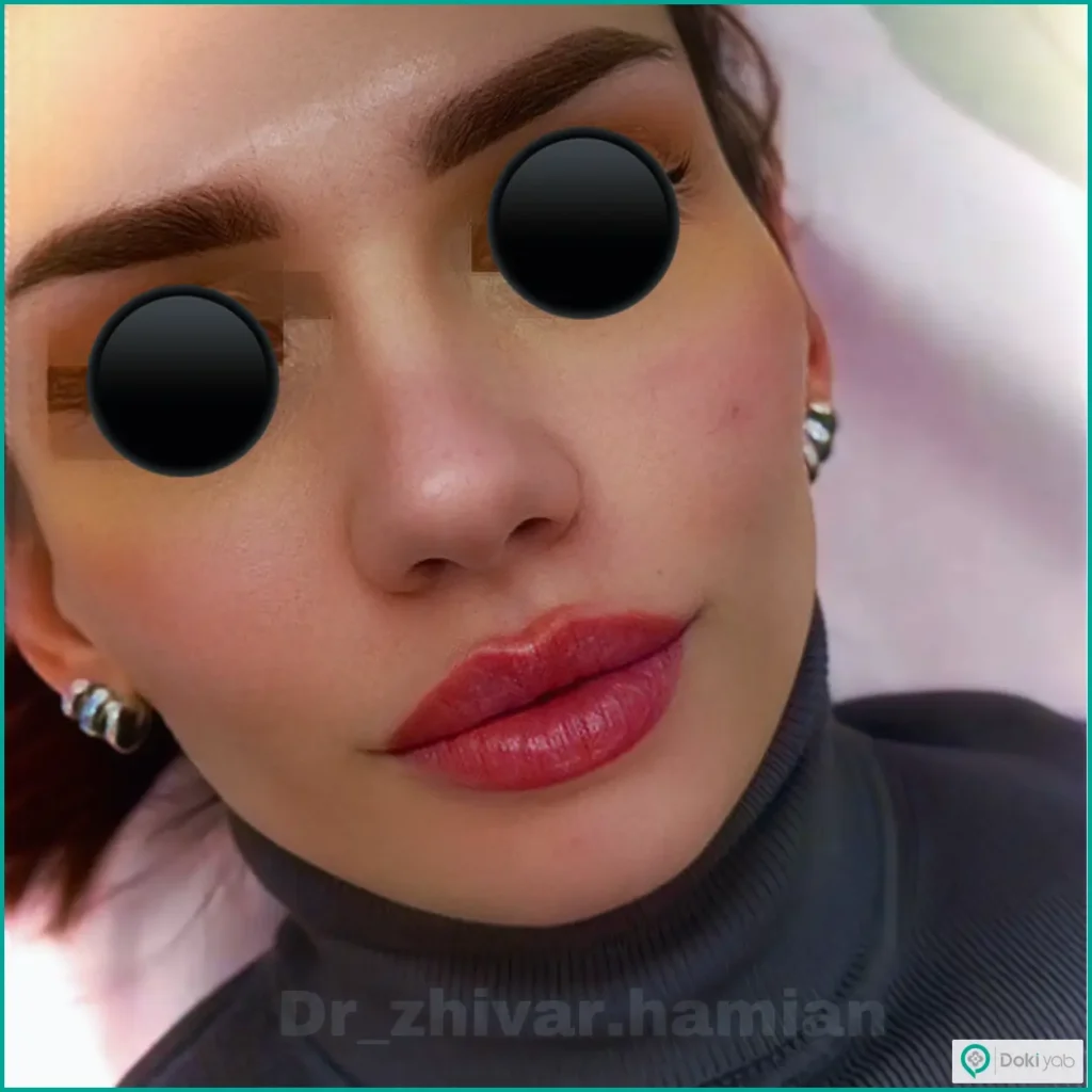 تزریق ژل لب قلبی - Kimiara Pharmaceutical Company