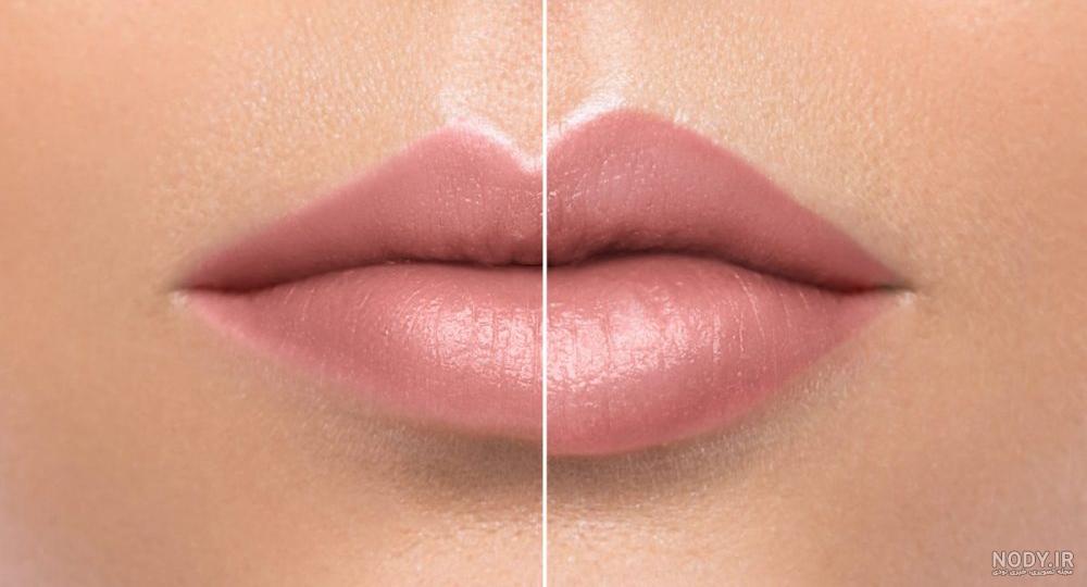 تزریق ژل لب قلبی، مزایا، معایب، هزینه مربوط به آن