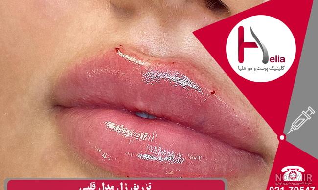 تزریق ژل لب مدل باربی: انواع مدل های تزریق ژل لب و انواع فرم لب، بهترین  مارک بوتاکس و ژل