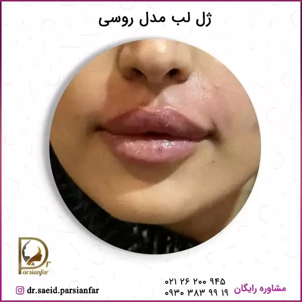 تزریق ژل لب مدل روسی | تزریق پروتز لب روسی و قیمت | قیمت تزریق ژل لب روسی | دکتر گیتا مجیدزاده تزریق ژل لب مدل روسی | تزریق پروتز لب روسی و قیمت | قیمت تزریق ژل لب روسی | دکتر گیتا مجیدزاده