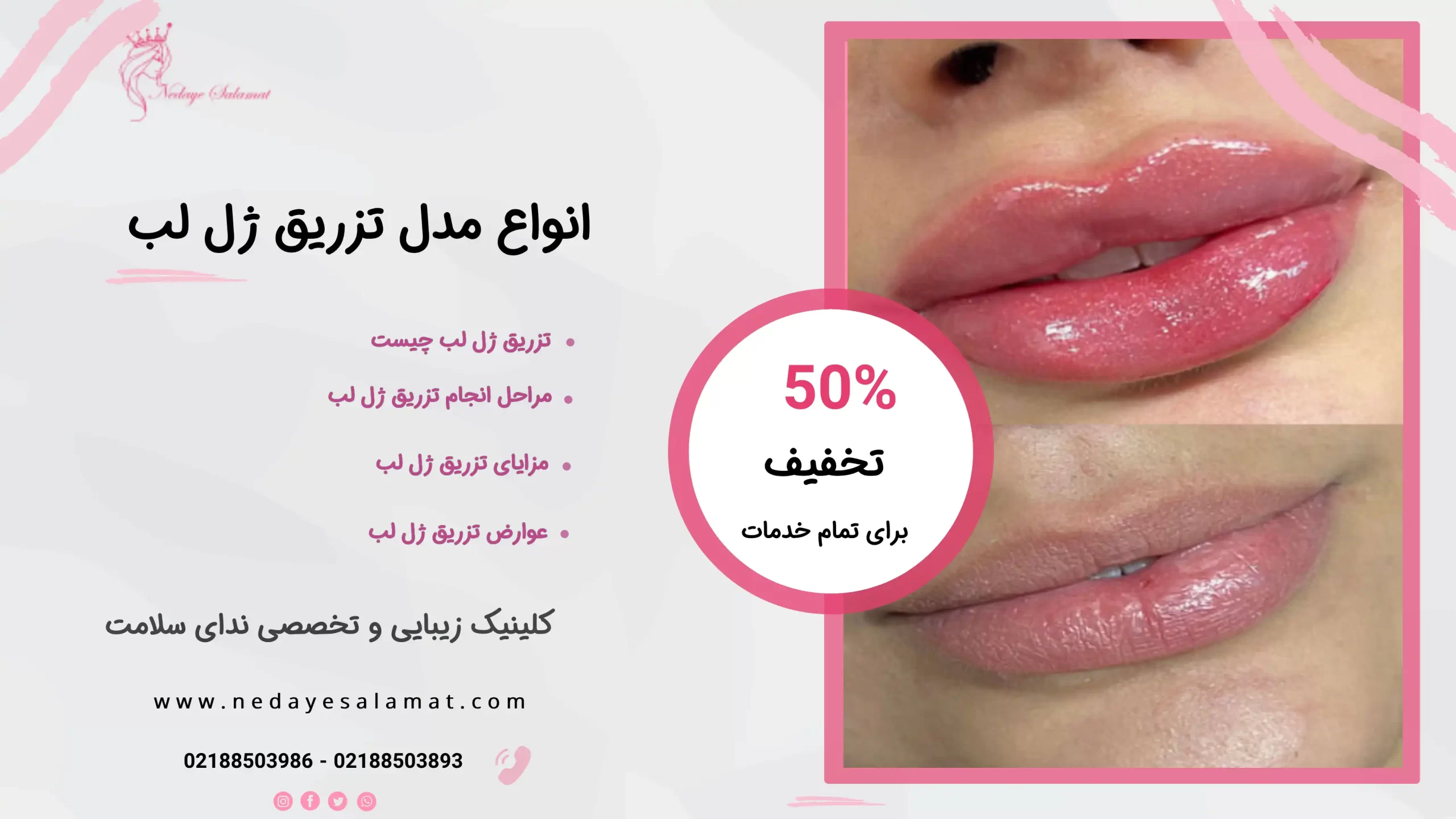 تزریق ژل لب مدل روسی + ماندگاری و عوارض آن ← (آپدیت آذر 1403) تزریق ژل لب مدل روسی + ماندگاری و عوارض آن ← (آپدیت آذر 1403)