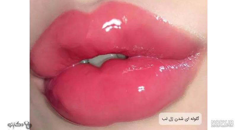 تزریق ژل لب مدل روسی | مزایا، عوارض، ماندگاری، مراقبت ها و هزینه