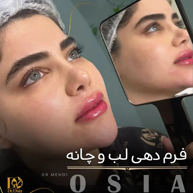 تزریق ژل لب مدل روسی | مزایا، عوارض، ماندگاری، مراقبت ها و هزینه