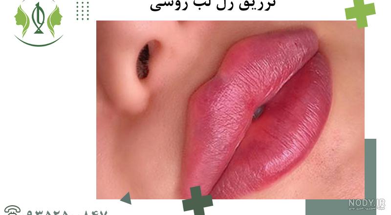 تزریق ژل لب مدل روسی چگونه است؟ همه چیز در مورد آن تزریق ژل لب مدل روسی چگونه است؟ همه چیز در مورد آن