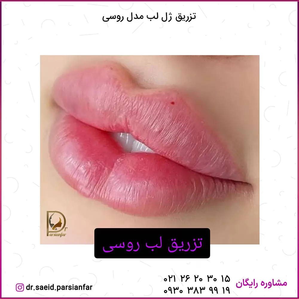 تزریق ژل لب مدل عروسکی در اصفهان تزریق ژل لب مدل عروسکی در اصفهان