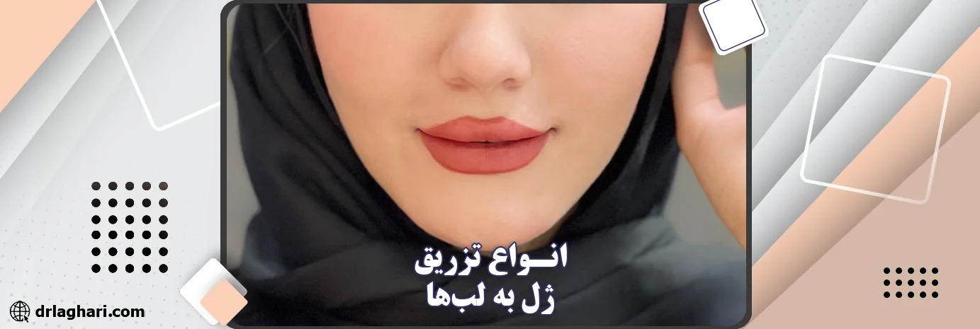 تزریق ژل لب مدل قلبی تزریق ژل لب مدل قلبی
