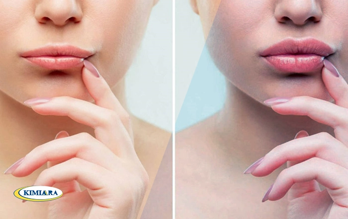 تزریق ژل لب مدل قلبی تزریق ژل لب مدل قلبی