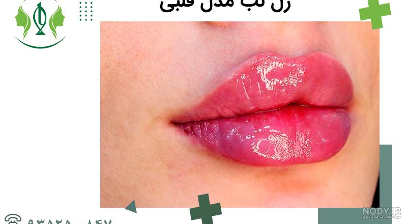 تزریق ژل لب مدل قلبی در【سال ۱۴۰۳】✓ | دکتر حمیدرضا بهمنی