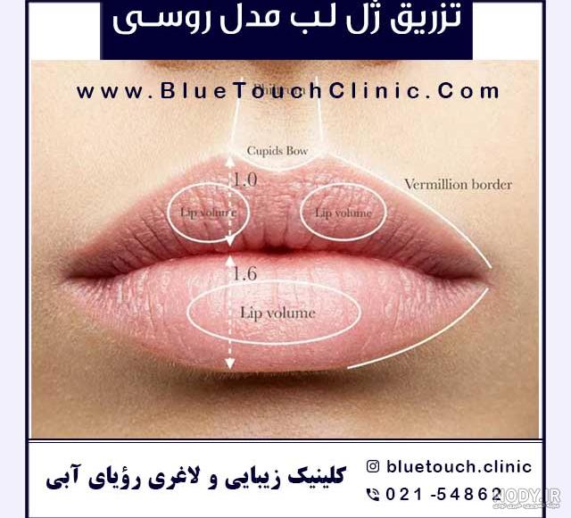 تزریق ژل لب مدل قلبی + نکات مراقبتی و قیمت - آی گل