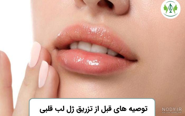 تزریق ژل لب مدل قلبی چیست؟